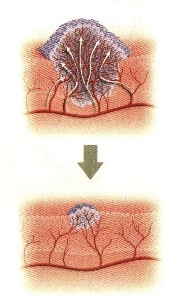 angiogenese.jpg